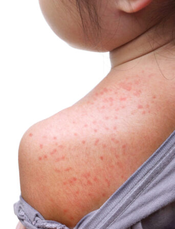 Measles appearance