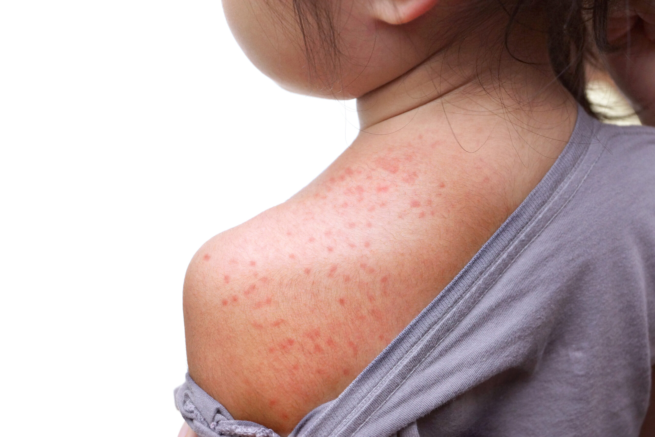 Is Your Team Ready for the Next Measles Outbreak?: How to Prepare for Measles in the 21st Century